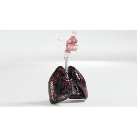 3D Respiratory System Smoker's Lungs heavy stage